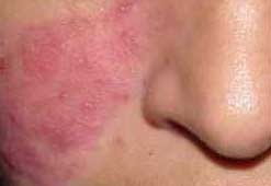 acne vulgaris