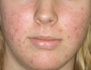 acne vulgaris